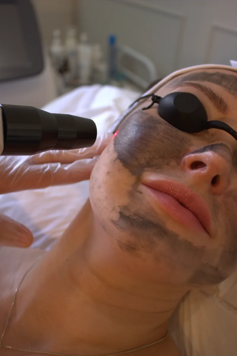 Carbon laser facial treatment in progress